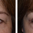 blog logo of The Seattle Eyelid & Blepharoplasty Center