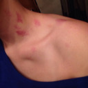 Hickeys.