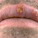 blog logo of Blue Waffles Disease Infection , Pictures, Symptoms in Women & M